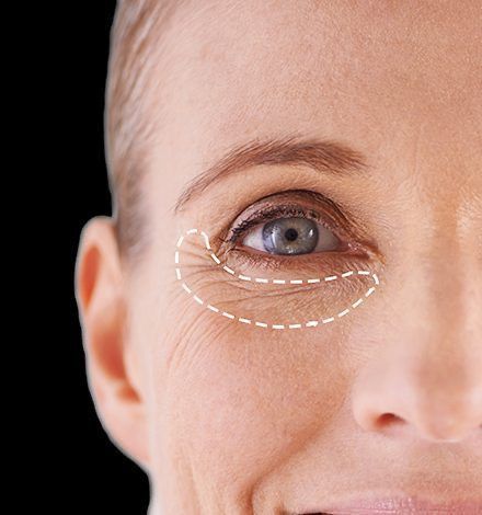 Cover Tratament radiofrecventa periocular